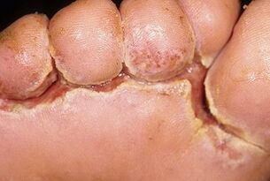 objawy grzybicy paznokci
