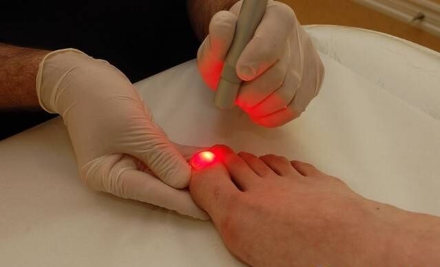 laserowe leczenie grzybicy paznokci