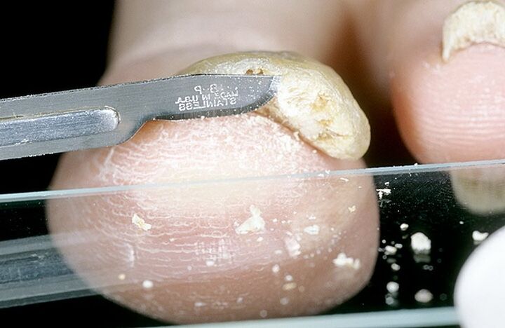 skrobanie paznokci w celu zdiagnozowania grzybicy