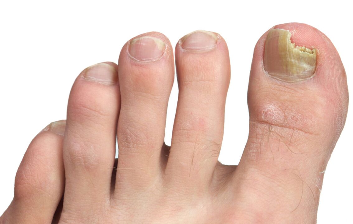 zdjęcie grzyba paznokci u stóp