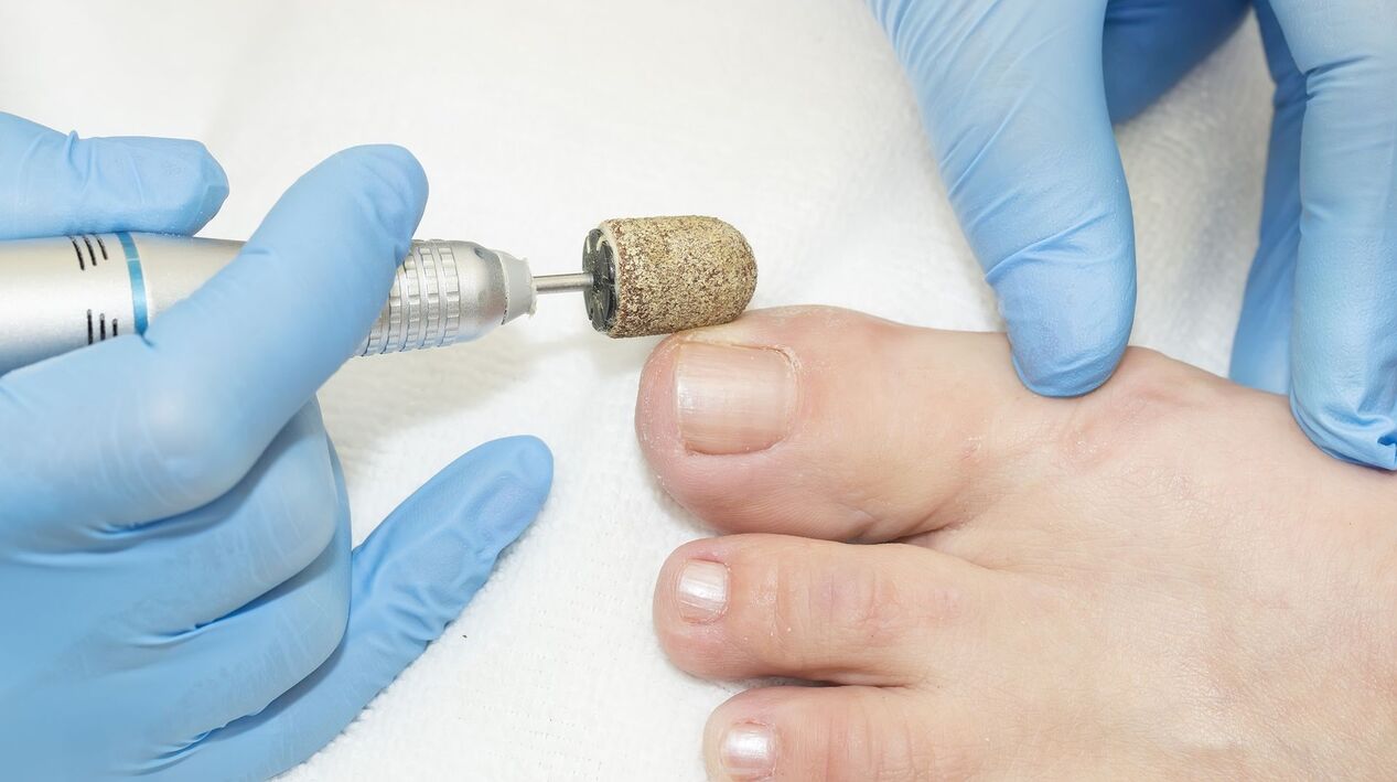 sprzętowe leczenie grzyba na paznokciach u nóg