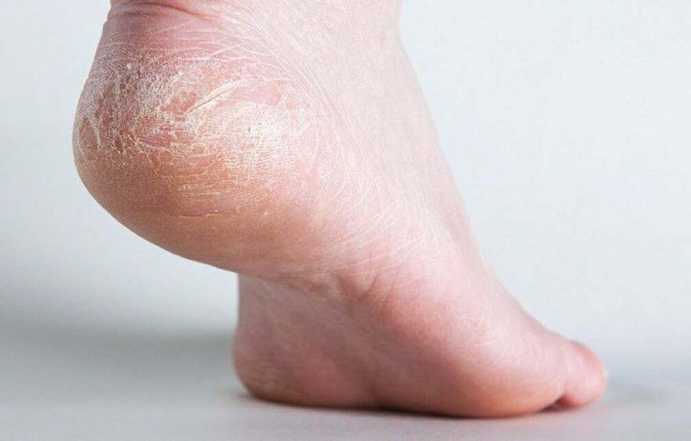 grzyb skóry na nodze jak leczyć