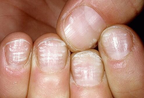 infekcja grzybicza płytki paznokcia
