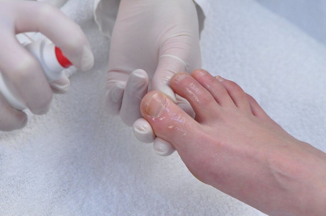 leczenie grzybicy paznokci