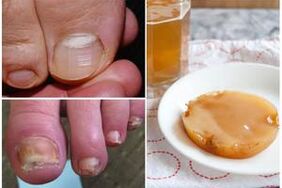 Kombucha to popularny środek ludowy stosowany w leczeniu grzybicy paznokci. 