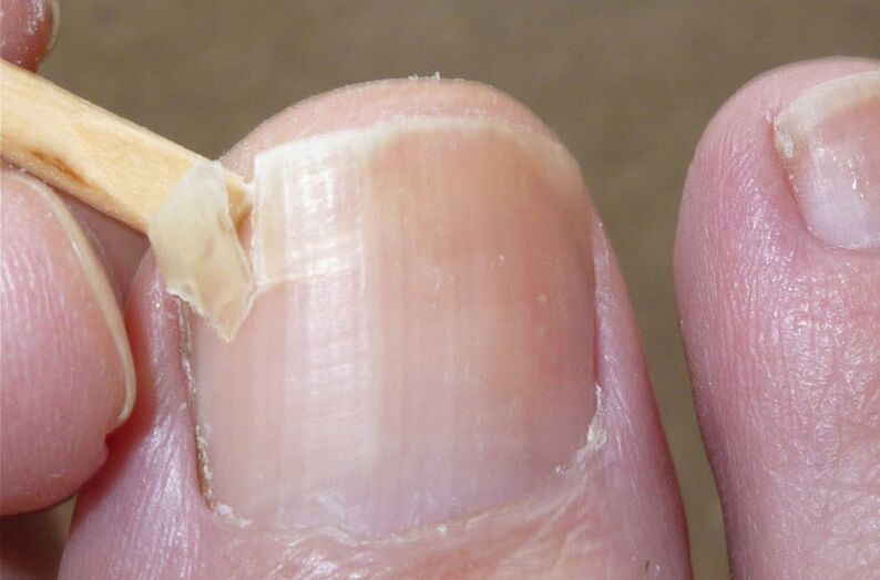 Uszkodzone paznokcie są czynnikiem ryzyka infekcji grzybiczej