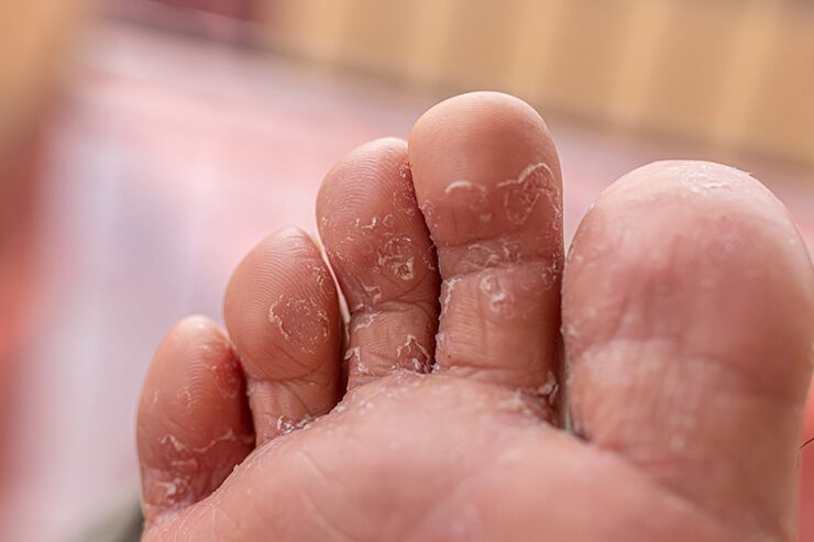 Finger Skin Fungus - etap początkowy
