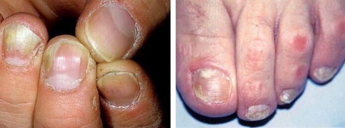 objawy infekcji grzybiczej na paznokciach