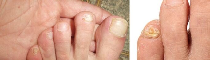 zdjęcie objawów grzyba na paznokciach u nóg
