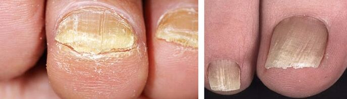 uszkodzenie paznokci z infekcją grzybiczą