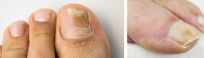 zdjęcie infekcji grzybiczej paznokcia dużego palca u nogi
