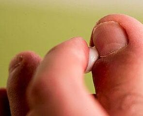 grzyb paznokci stóp