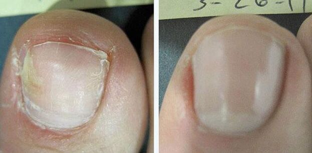 przed i po leczeniu grzybicy paznokci