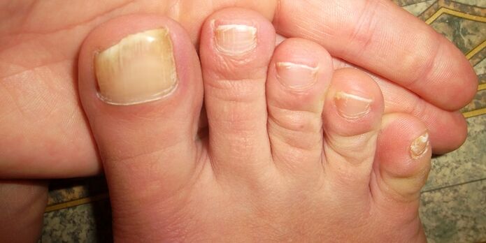 uszkodzenie paznokci u nóg przez grzyby