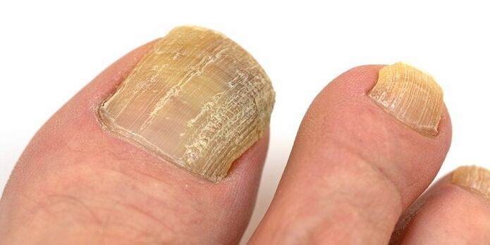 uszkodzenie paznokci z zaawansowaną infekcją grzybiczą