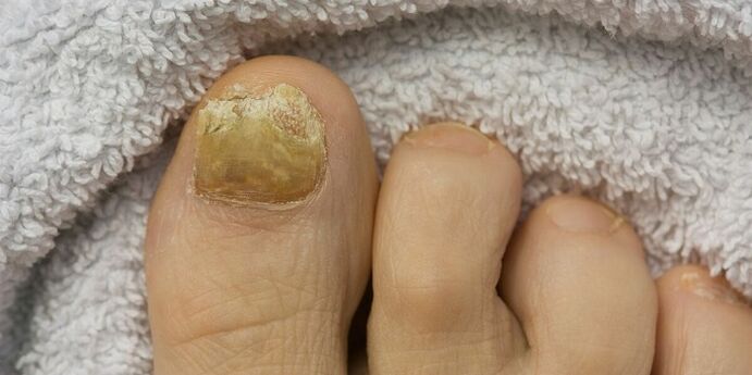 żółty paznokieć z infekcją grzybiczą