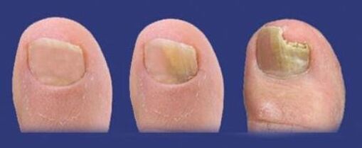 etapy rozwoju grzyba na paznokciach stóp