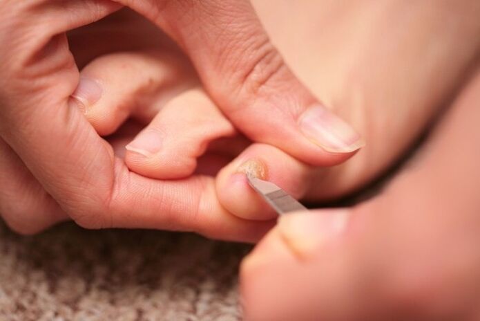 Leczenie przeciwgrzybicze paznokci