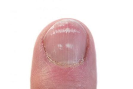 początkowy etap infekcji grzybicą paznokci