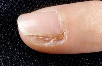 usunięcie części paznokcia z grzybem